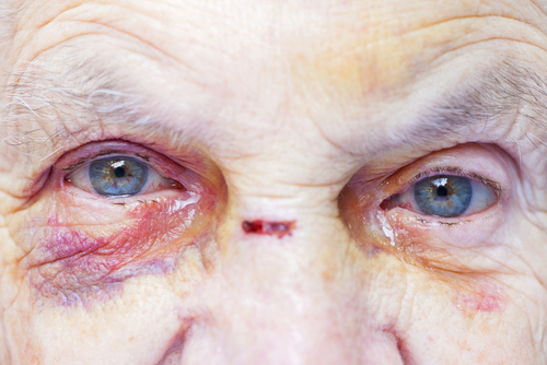 Maltraitance des personnes âgées - Coups et blessures - Préjudice